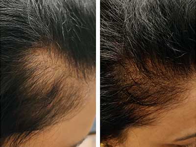 Ayurvedic Doctor for Hair Fall in Moshi, Pimpri-Chinchwad