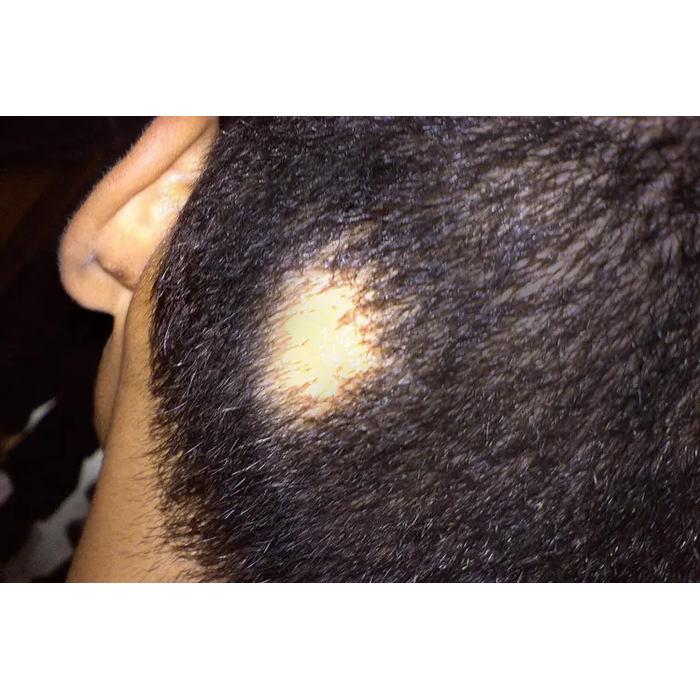 Alopecia Ayurvedic Treatment  