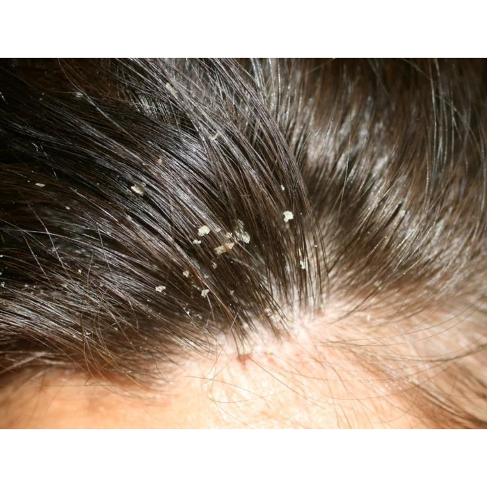 Dandruff and Hair Fall Treatment  